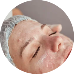 Acne gezichtsbehandeling